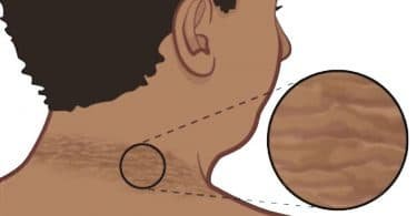 Remedios caseros para blanquear el cuello en 20 minutos