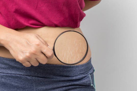  Vicks Vaporub para estrias