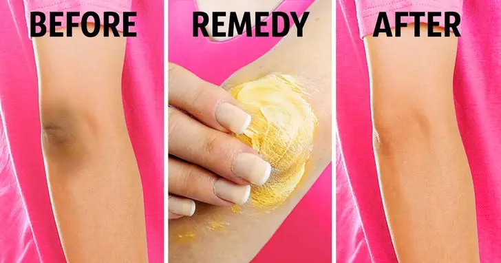 blanquear rodillas y codos oscuros