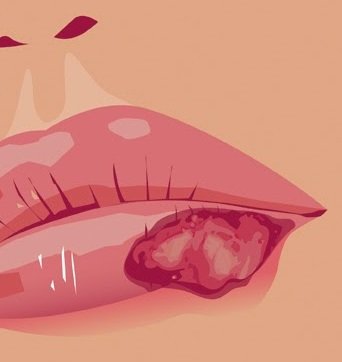 herpes labial vicks vaporub