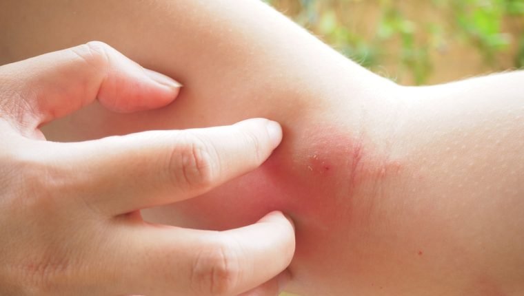  Vicks Vaporub picaduras de insectos