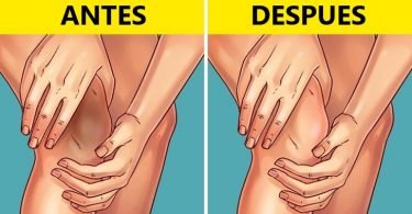 blanquear rodillas y codos oscuros