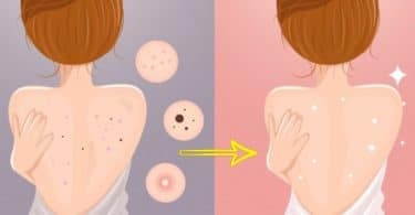 Remedios caseros para el acne en la espalda