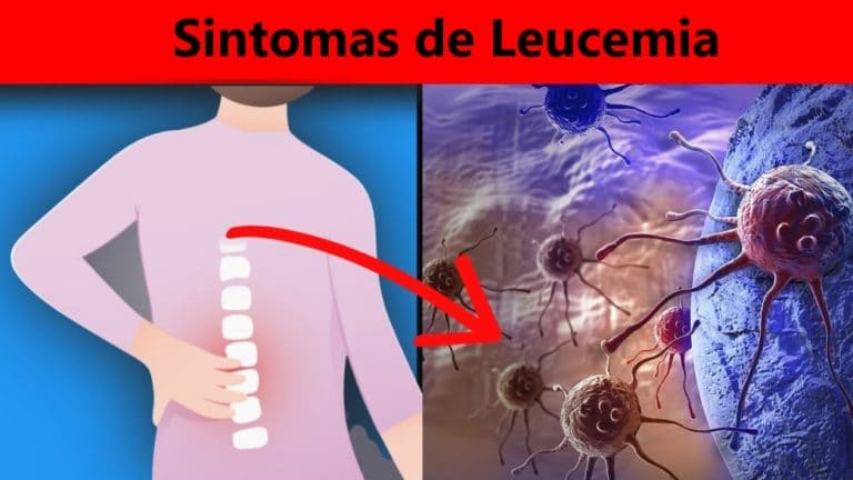 Conoce Estos 15 Síntomas De Leucemia Que Son Silenciosos Batidos 4079